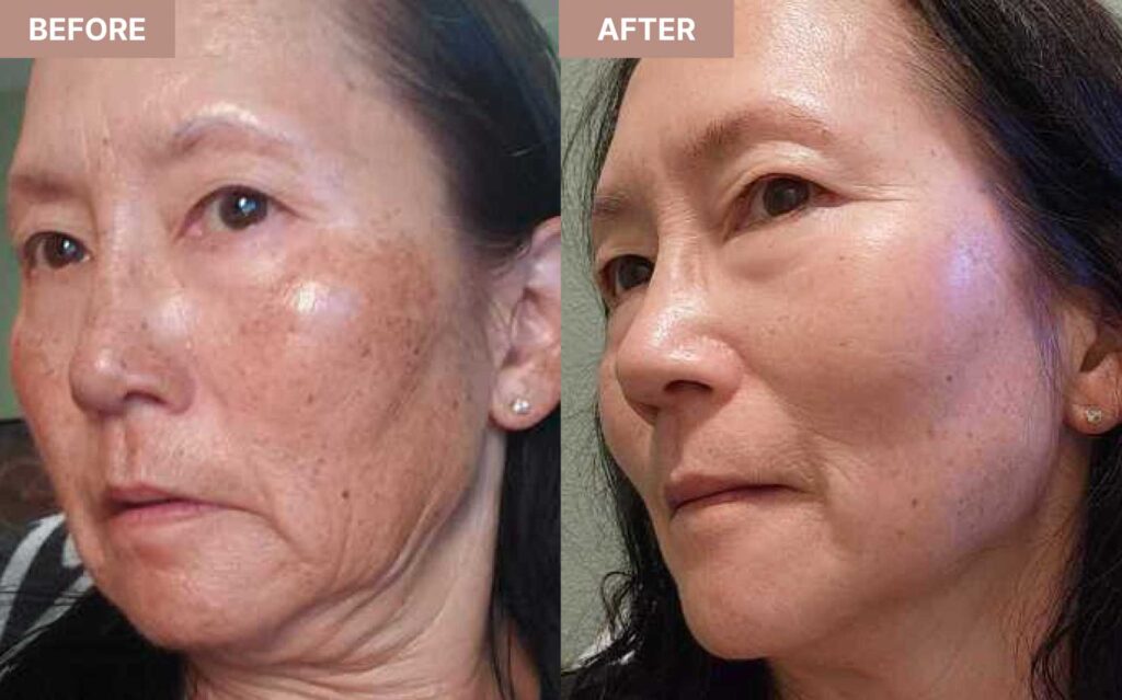 Tretinoin cream benefits for wrinkles