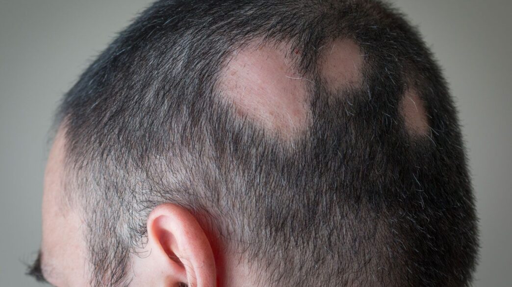 “Treatment options for Alopecia Areata: medical illustration showing patchy hair loss on scalp.