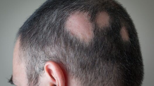 “Treatment options for Alopecia Areata: medical illustration showing patchy hair loss on scalp.
