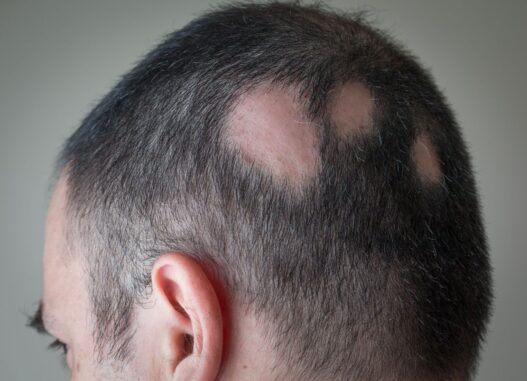 “Treatment options for Alopecia Areata: medical illustration showing patchy hair loss on scalp.
