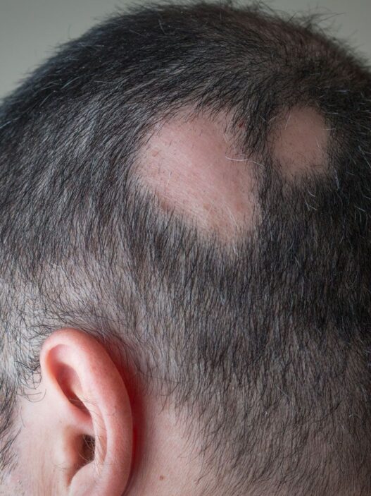 “Treatment options for Alopecia Areata: medical illustration showing patchy hair loss on scalp.