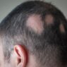 “Treatment options for Alopecia Areata: medical illustration showing patchy hair loss on scalp.
