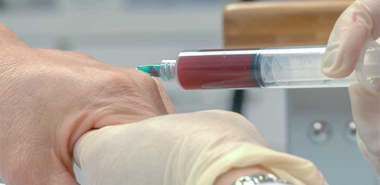 “Platelet-rich plasma (PRP) therapy being prepared as a supportive treatment for Alopecia Areata.
