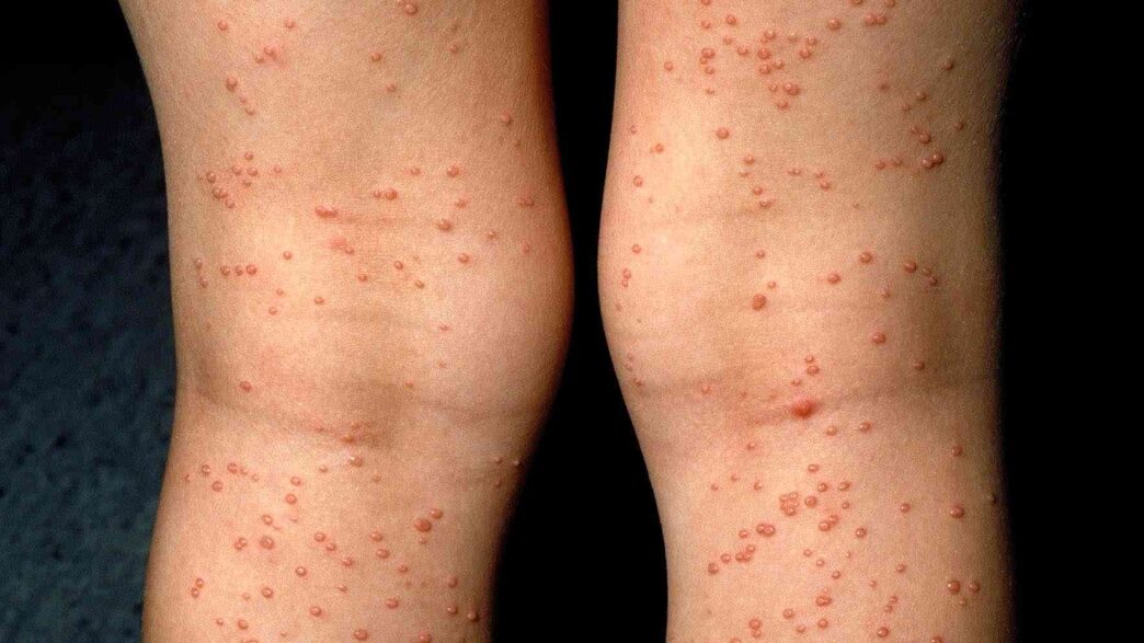 types of skin rashes with pictures