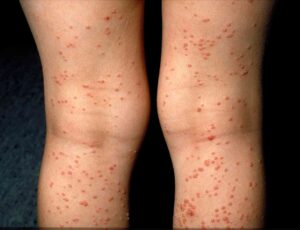 types of skin rashes with pictures