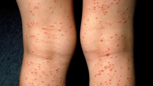 types of skin rashes with pictures