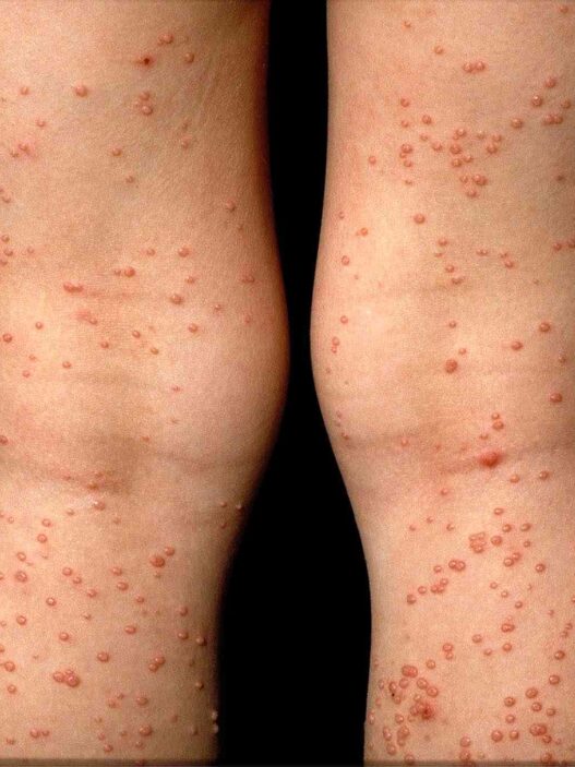 types of skin rashes with pictures