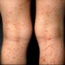 types of skin rashes with pictures