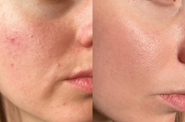 “Before and after results of rose water skin care for glowing skin