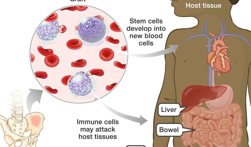 Graft-Versus-Host Disease