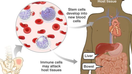 Graft-Versus-Host Disease