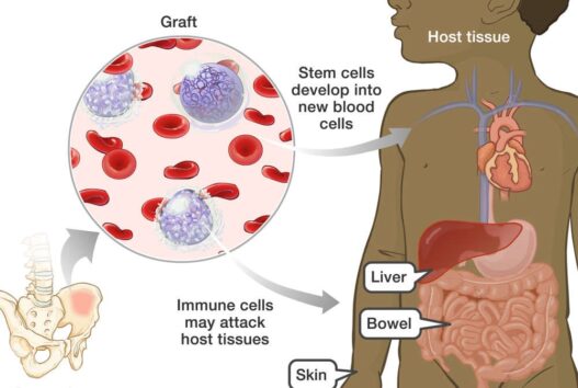 Graft-Versus-Host Disease
