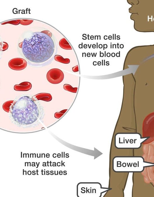 Graft-Versus-Host Disease