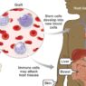 Graft-Versus-Host Disease
