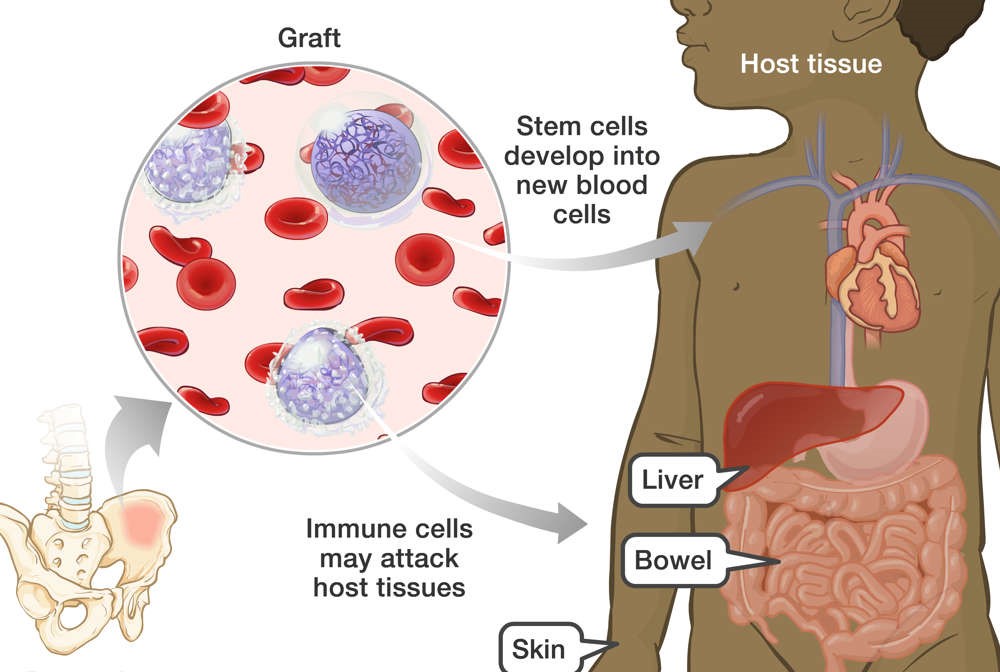 Graft-Versus-Host Disease